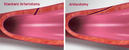 Image: A comparison between standard arteriotomy and arstaotomy (photo courtesy Arstasis).